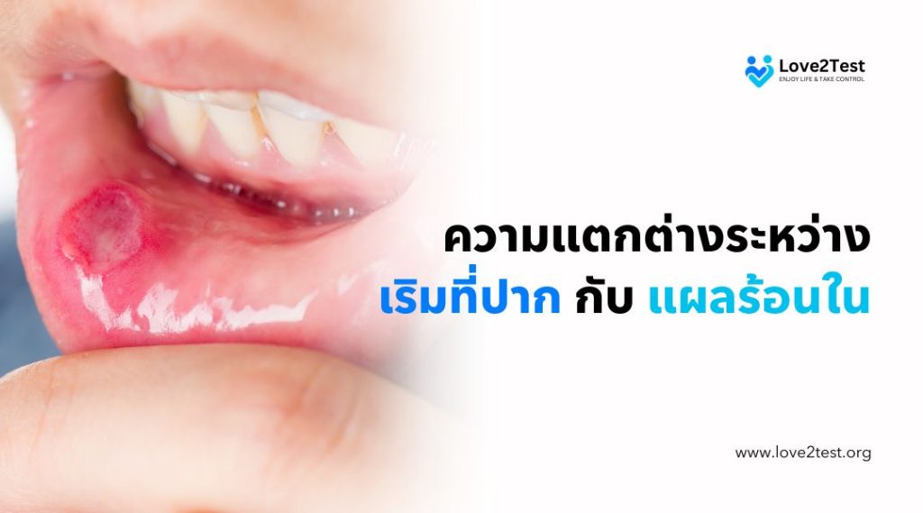 ความแตกต่างระหว่าง เริมที่ปาก กับ แผลร้อนใน