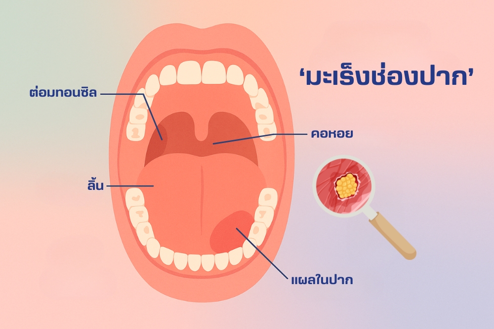 เชื้อ HPV มะเร็งช่องปาก