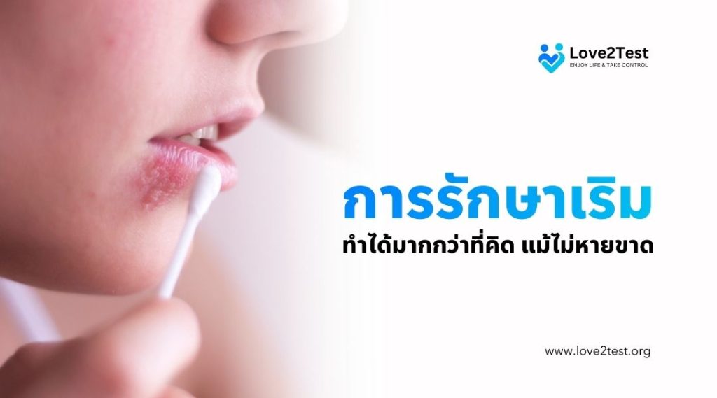 การรักษาเริม ทำได้มากกว่าที่คิด แม้ไม่หายขาด